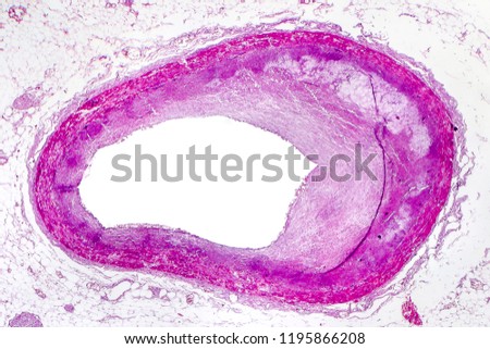 Coronary atherosclerosis, light micrograph showing cholesterol-containing plaque in heart coronary artery, photo under microscope