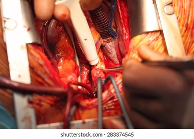 Coronary Bypass Surgery Surgeons Work Closeup