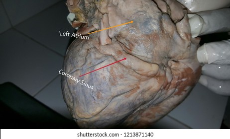 Coronary Sinus Of Human Heart 