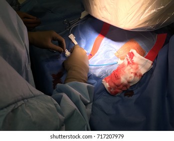 Coronary Sinus Incannulation During A CRT Extraction Procedure