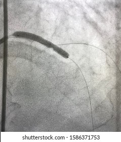 Coronary Stent Was Deployed At Left Main To Proximal LAD During Percutaneous Coronary Intervention (PCI)