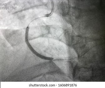 A Coronary Stent Deployed At Mid Right Coronary Artery (RCA) During Percutaneous Coronary Intervention (PCI).