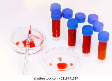 Coronavirus Blood Sample COVID-19. Petri Dish And Test Tubes With Blood In The Laboratory. Blood Coronavirus Test.Virus Vaccine Development.Pipette And Petri Dish.Virus Research.