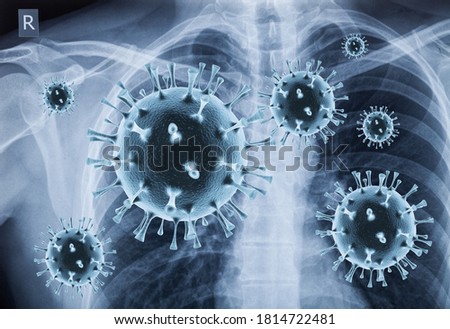 Coronavirus disease COVID-19 virus infection in human lungs x-ray