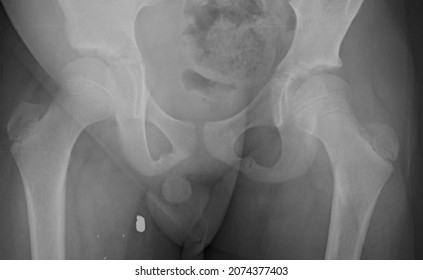 Corpus Alienum Bullet  On Right Leg After Gun Shot , X Ray Radiology