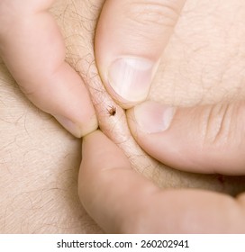correct removing a tick from skin of patient