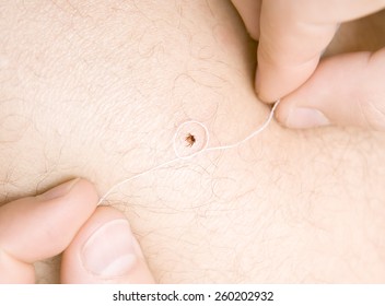 correct removing a tick with thread from skin of patient