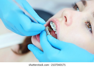 Correction of braces during wearing. A visit to an orthodontist. A girl with braces on her teeth. Open mouth. Modern dentistry.Photo in a real clinic.
