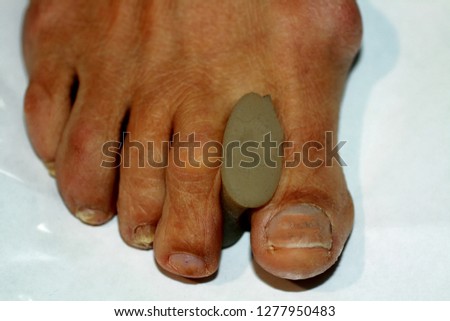 Correction of the curvature of the toe