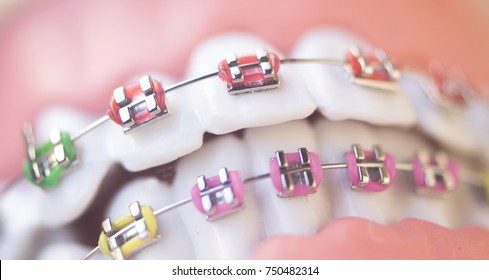 Cosmetic Dentistry Orthodontics Dental Metal Wire Teeth Brackets Teaching Student Model.