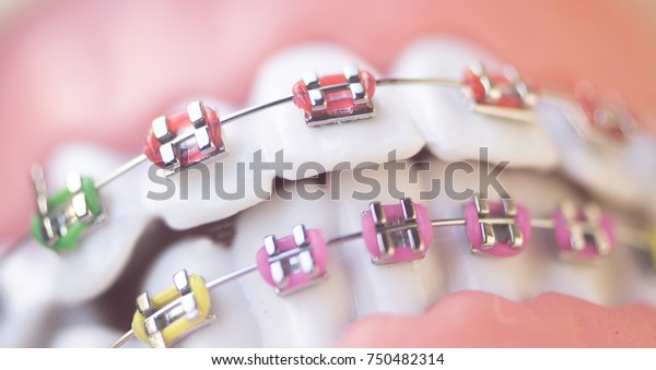 Cosmetic dentistry orthodontics dental
metal wire teeth brackets teaching student
model.