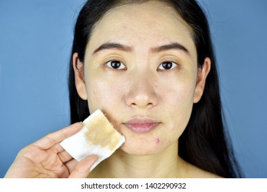 Cosmetic Makeup Remover, Asian Woman Cleaning Face With Cotton Pad, Bare Face Skin And Pimple At Chin, Cosmetic Acne.