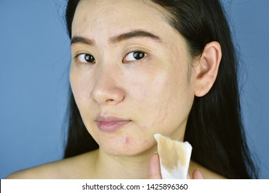 Cosmetic Makeup Remover, Asian Woman Cleaning Face With Cotton Pad, Bare Face Skin And Pimple At Chin, Cosmetic Acne.