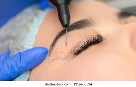 Cosmetic procedure to strengthen the skin of the eyelids. Non-surgical blepharoplasty on plasma IQ apparatus. Cosmetology for facial rejuvenation.