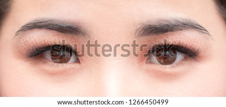 Cosmetic procedure to strengthen the skin of the eyelids. Non-surgical blepharoplasty on plasma IQ apparatus. Cosmetology for facial rejuvenation.