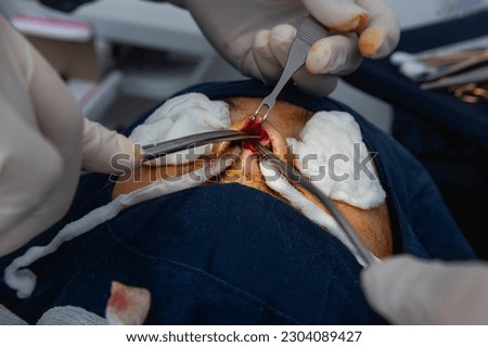 A cosmetic surgeon uses a nasal retractor to hold back a flap of skin tissue while cutting with a pair of dorsal scissors. Open rhinoplasty and tip plasty procedure.