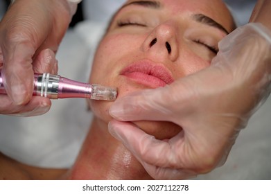 Cosmetician makes microneedling, care to the patient using dermapen