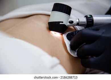 A cosmetologist doctor in black gloves examines the patient's mole using a dermatoscope. Close-up