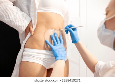 cosmetologist doctor makes markings the patient's abdomen before the coolsculpting procedure in cosmetology clinic  the doctor draws lines the woman's body before fat removal surgery