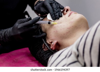 Cosmetologist Doctor Is Making Multiple Injections Biorevitalization With Hyaluronic Acid In Woman Face Skin, Closeup