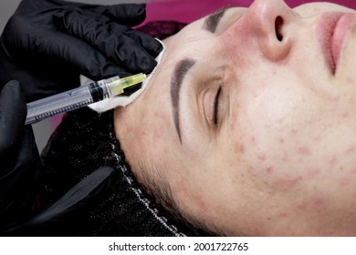 Cosmetologist Doctor Is Making Multiple Injections Biorevitalization With Hyaluronic Acid In Woman Face Skin, Closeup. Woman On The Procedure Of Mesotherapy Injection.