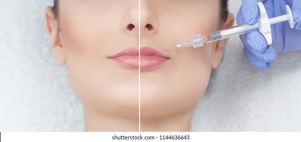 The cosmetologist makes injections of botulinum toxin in the lips of the patient. Close-up photo before and after procedure