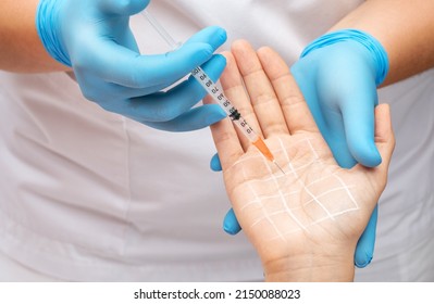The cosmetologist makes injections of botulinum toxin on the palms of a woman against hyperhidrosis. Women's cosmetology, skin care. - Shutterstock ID 2150088023