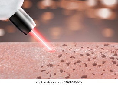 Cosmetology Procedure Laser Freckle Skin Removal On Body Parts. Close Up