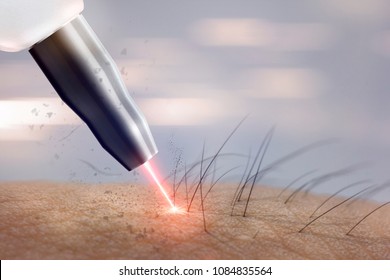Cosmetology Procedure Laser Hair Removal On Body Parts. Laser Epilation.