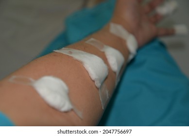 A Cotton Ball And Sanitary Tape Is Placed On The Arm And Hand Site Where Blood Was Drawn For A Medical Test  