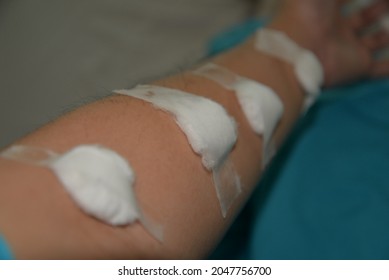 A Cotton Ball And Sanitary Tape Is Placed On The Arm And Hand Site Where Blood Was Drawn For A Medical Test  