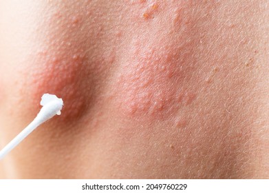 cotton swab treatment of skin rash. Shingles, varicella-zoster virus. skin rash and blisters on body. Skin infected Herpes zoster virus. Herpes Virus on body. urticaria rash. atopic dermatitis.