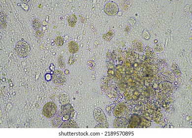 Coughing Up Mucus And Phlegm From A Chest Infection From A Virus And Bacteria Infection, Looking At It Under The Microscope, With Cells And Microorganisms. Bacteria And Skin Cells Close Up