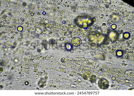 Coughing up mucus and phlegm from a chest infection from a virus and bacteria infection, looking at it under the microscope, with cells and microorganisms. Bacteria and skin cells in a human
