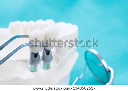 Couse up Implan model tooth support fix bridge implan and crown.