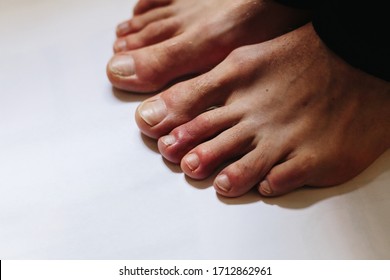 COVID toes . Another another symptom of coronavirus infection. Painful red and purple bumps that tend to occur at the tips of the toes or on the tops of the feet, or on the tops of the fingers.