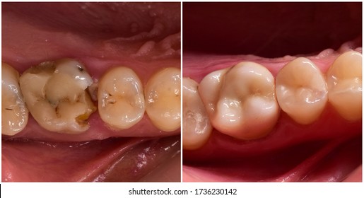  Cown And Composite Restoration Before And After Dental Treatment