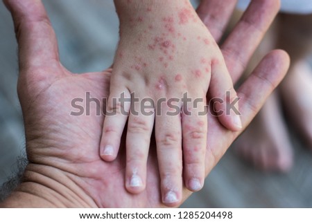 Coxsackie virus. Symptom of hand, ears, foot and mouth. Painful rash red spots blisters on the hand