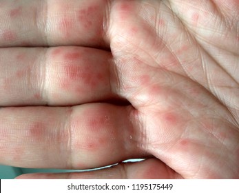Coxsackievirus (Coxsackie virus) symptoms. Hands with rash. Red sports on the hand, palm and fingers.