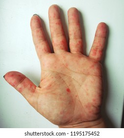 Coxsackievirus (Coxsackie virus) symptoms. Hands with rash. Red sports on the hand, palm and fingers.