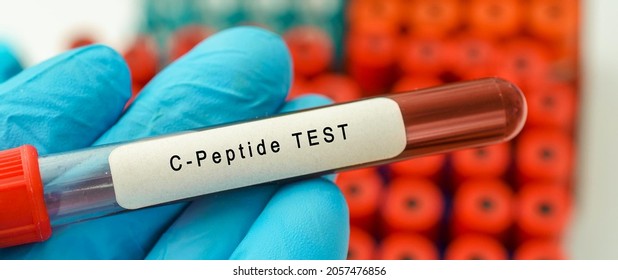 Cpeptide Test Result Blood Sample Test Stock Photo 2057476856 ...