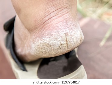 heel skin fissure
