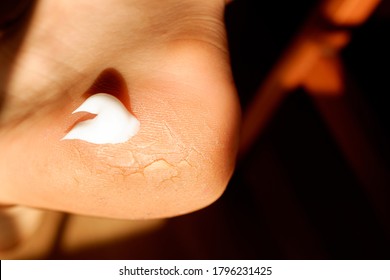 Cracked And Dry Skin On The Heel Of The Foot Treated With A Cream Rich In Urea.