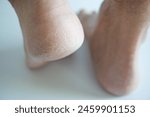 cracked feet heels close up - cornea skin - cracked men feet on white background - calluses callus, horny skin