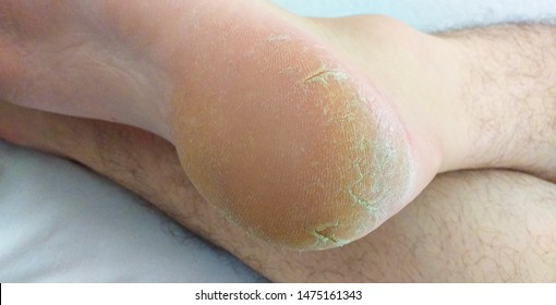 cracked feet heels close up - cornea skin - cracked men feet on white background - calluses callus, horny skin