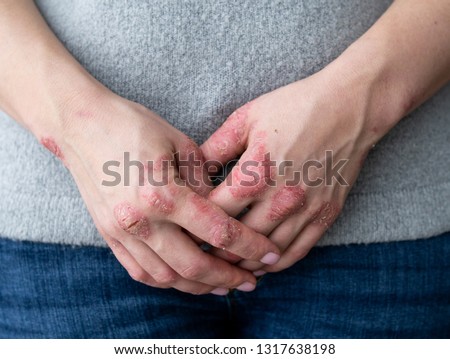 Cracked, flaky skin on the hands. Dermatological problems of psoriasis. Hard, horny and cracked skin on the finger in a woman's hands. Hand stains, dry skin. Psoriasis, allergy