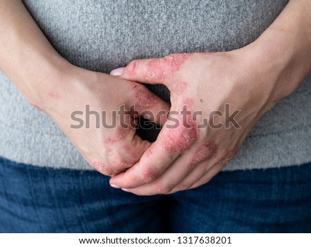 Cracked, flaky skin on the hands. Dermatological problems of psoriasis. Hard, horny and cracked skin on the finger in a woman's hands. Hand stains, dry skin. Psoriasis, allergy