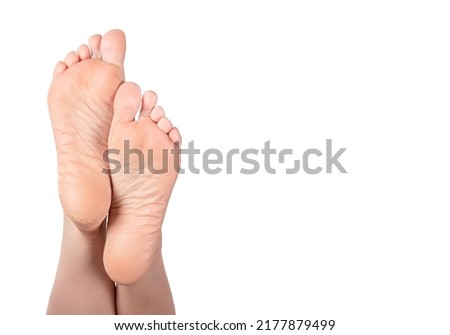 Cracked heel on woman's foot. Dry heels and soles woman on white background close up. Close up of Cracks on Heels with bad skin covered. Healthcare and medical concept.