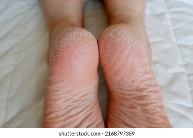 Cracked Heel. Skin Problems Caused By Dryness And Poor Circulation.