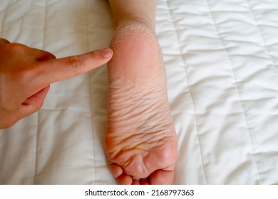 Cracked Heel. Skin Problems Caused By Dryness And Poor Circulation.